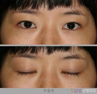 수술 전