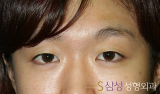 수술 전