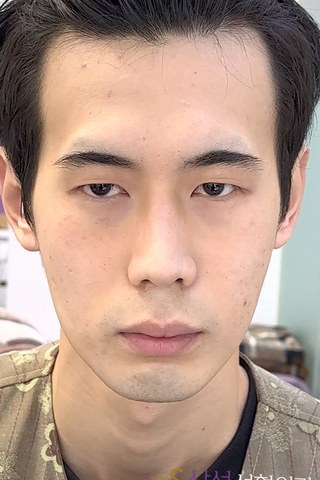 수술 전