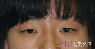 수술 전