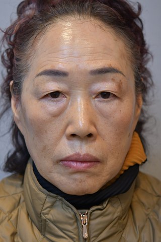 수술 전