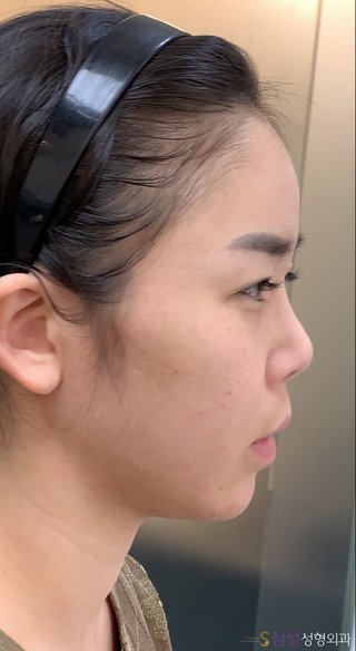 수술 전