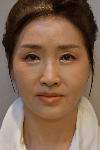 수술 전