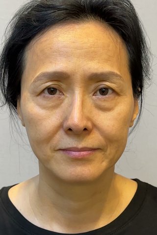 수술 전