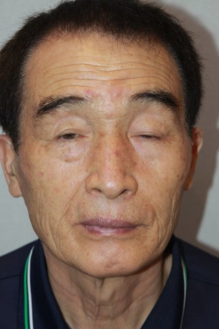 수술 전