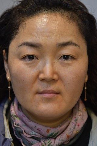 수술 전