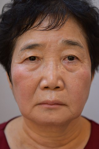 수술 전