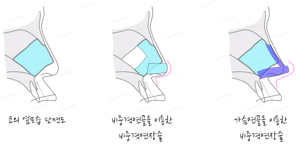 s_코성형02