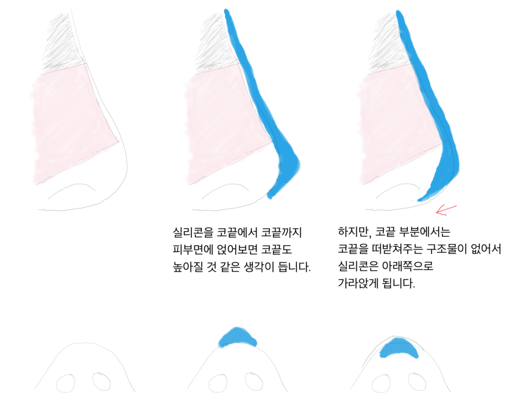 s_코성형02