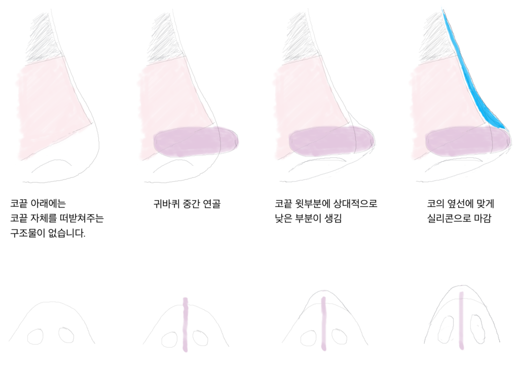 s_코성형02