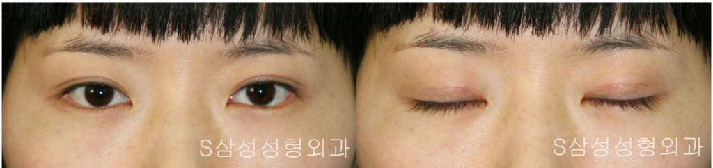 대구쌍꺼풀수술, 대구성형외과, 대구쌍수, 대구쌍꺼풀, 동성로성형외과, 대구동성로성형외과, 반월당성형외과, 대구에서쌍꺼풀잘하는곳