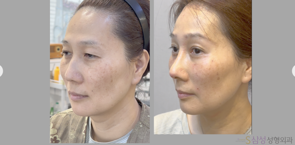 대구눈밑지방재배치, 쌍꺼풀수술, 안면거상술, 이마거상술, 상안검수술, 안검하성형술, 코성형에서 수술 후 모습