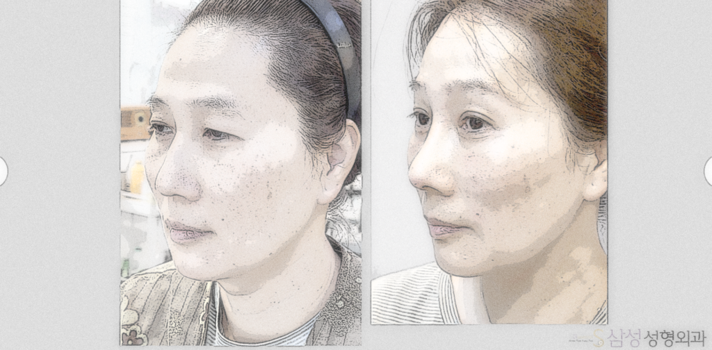 대구눈밑지방재배치, 쌍꺼풀수술, 안면거상술에서 수술 후 인상이 나빠지지 않기 위해 절대 잊어서는 안될 7가지 사항