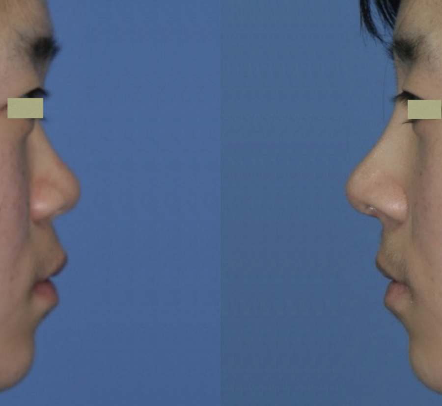 대구코성형, 대구코수술잘하는곳
