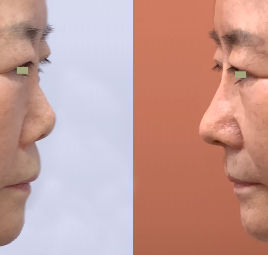 대구코성형, 대구코수술잘하는곳
