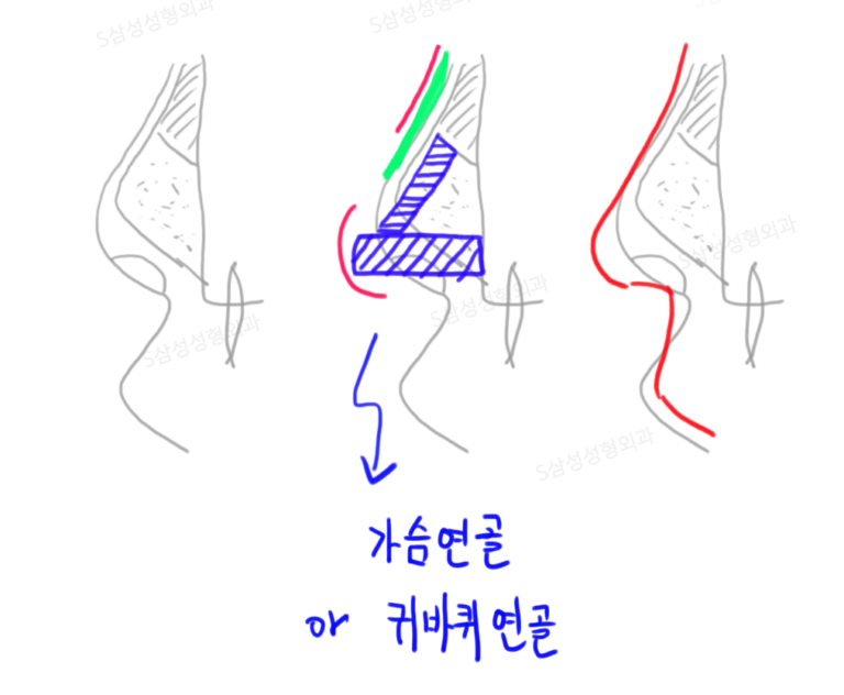 대구코성형-코수술잘하는곳