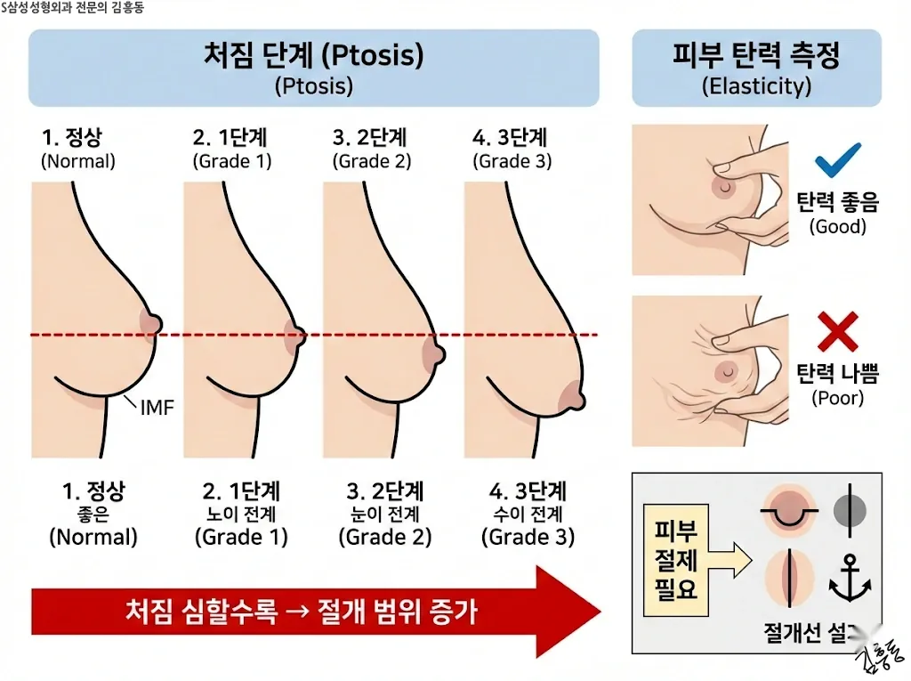 가슴 처짐 단계별 분류와 피부 탄력 측정