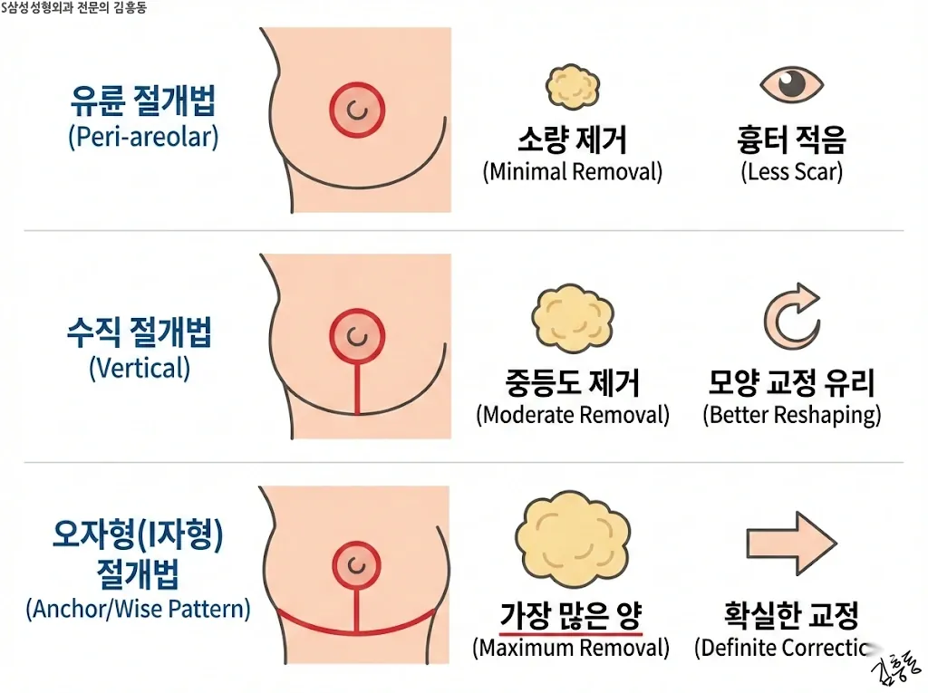 가슴 축소 수술법의 종류와 특징