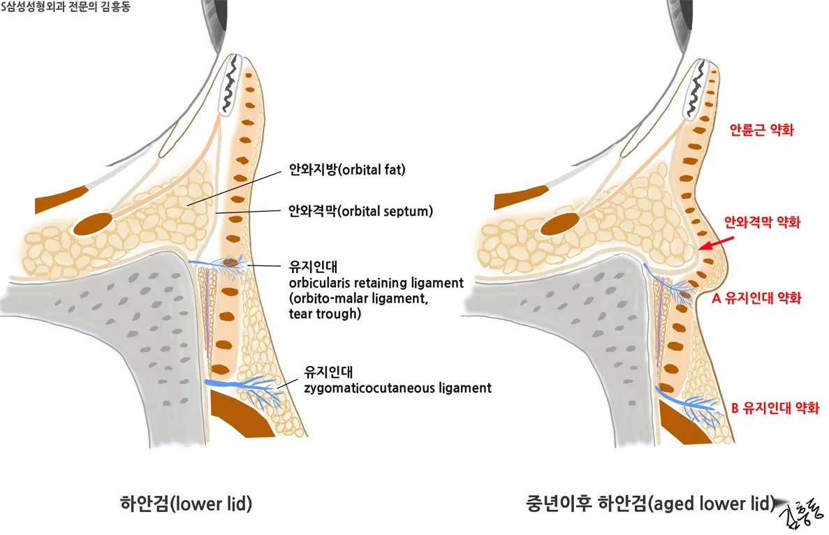 눈밑 지방주머니와 격막 개념