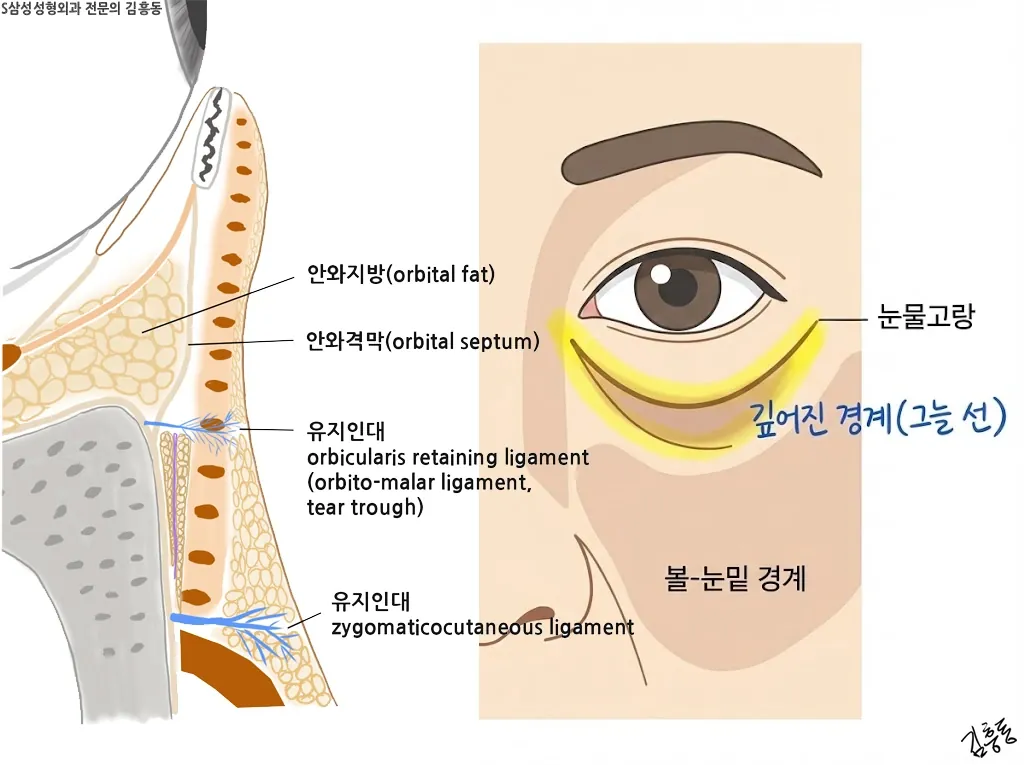 눈물고랑과 유지인대 경계