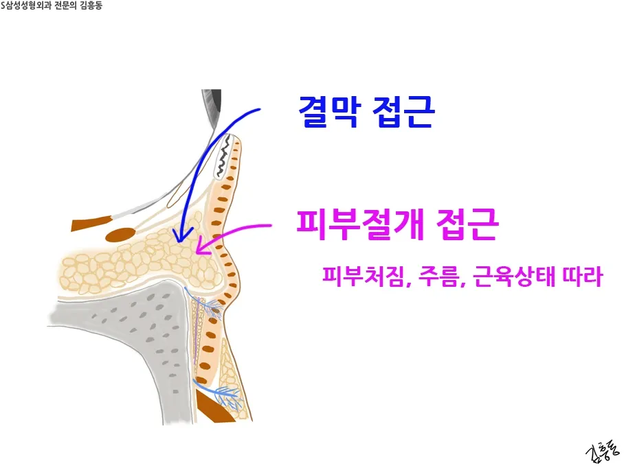 결막 접근과 피부 절개 접근 개념