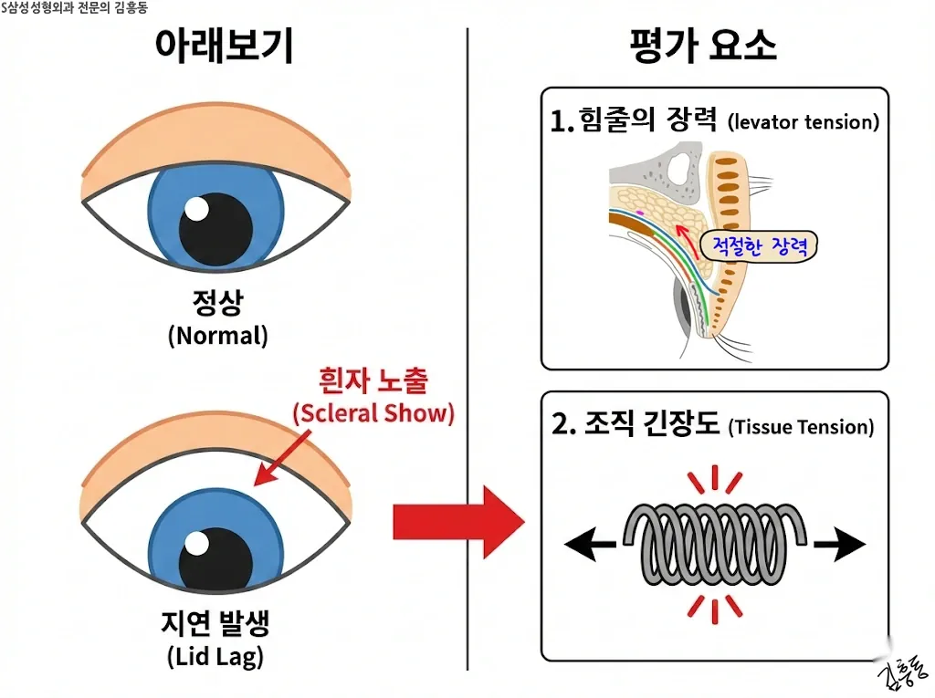 아래보기에서 떠 보임이 커지는 조건