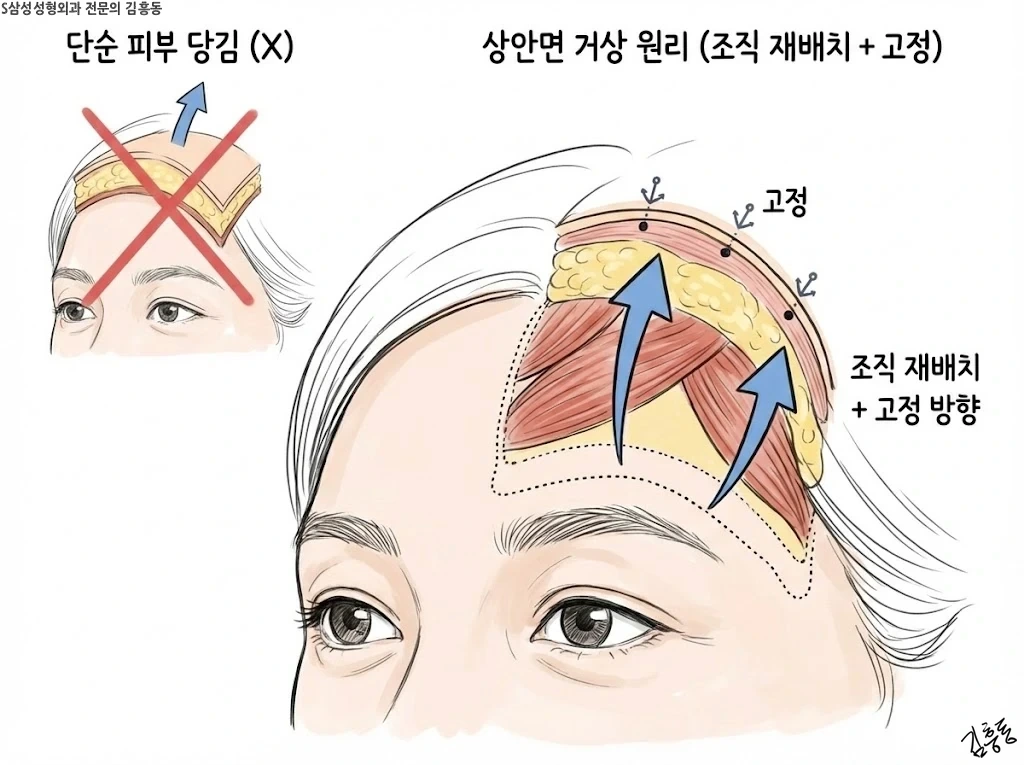 상안면 거상 원리 조직 재배치와 고정