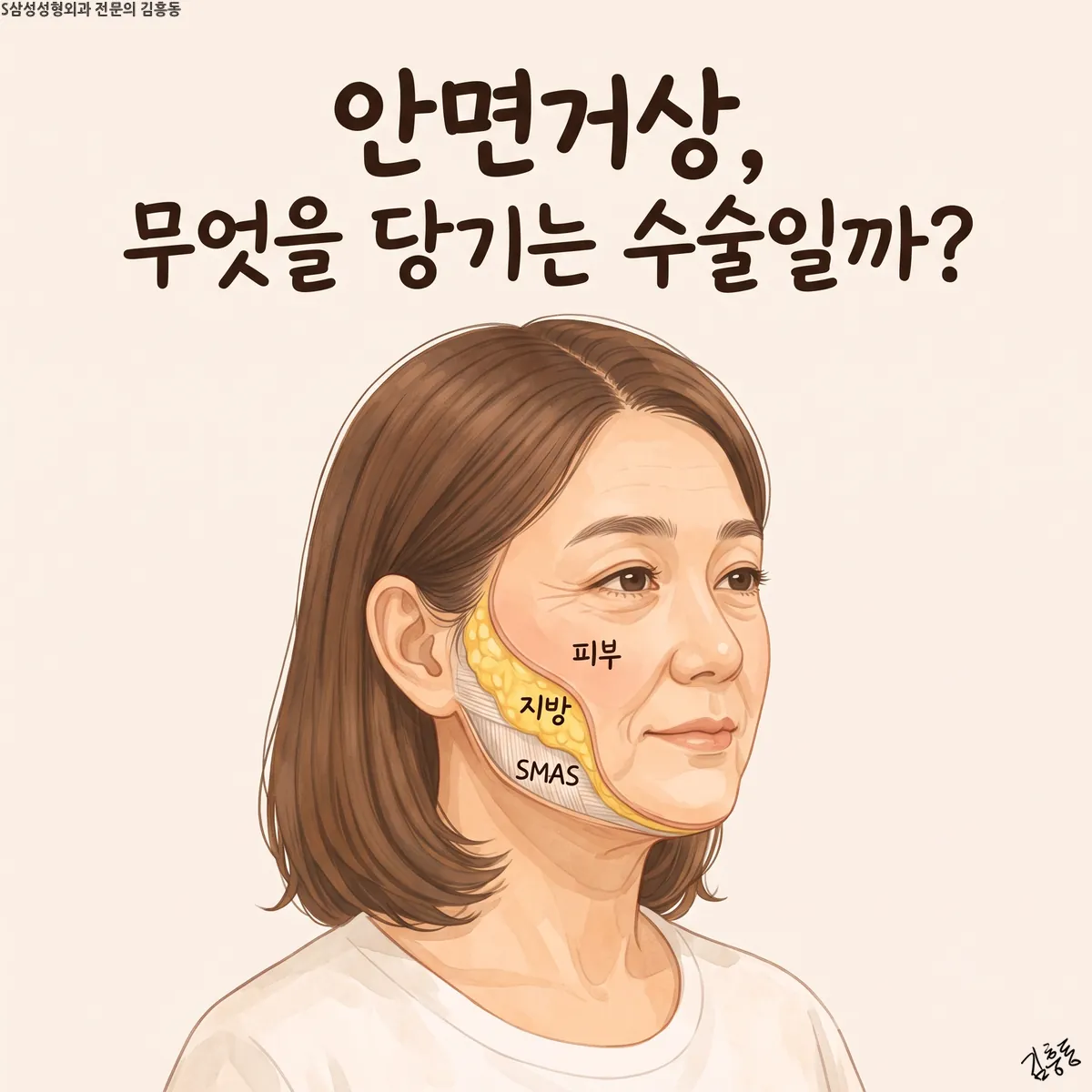 「안면거상, 무엇을 당기는 수술일까?」라는 제목이 적힌, 볼에 피부 · 지방 · SMAS 층을 표시한 여성 얼굴 그림
