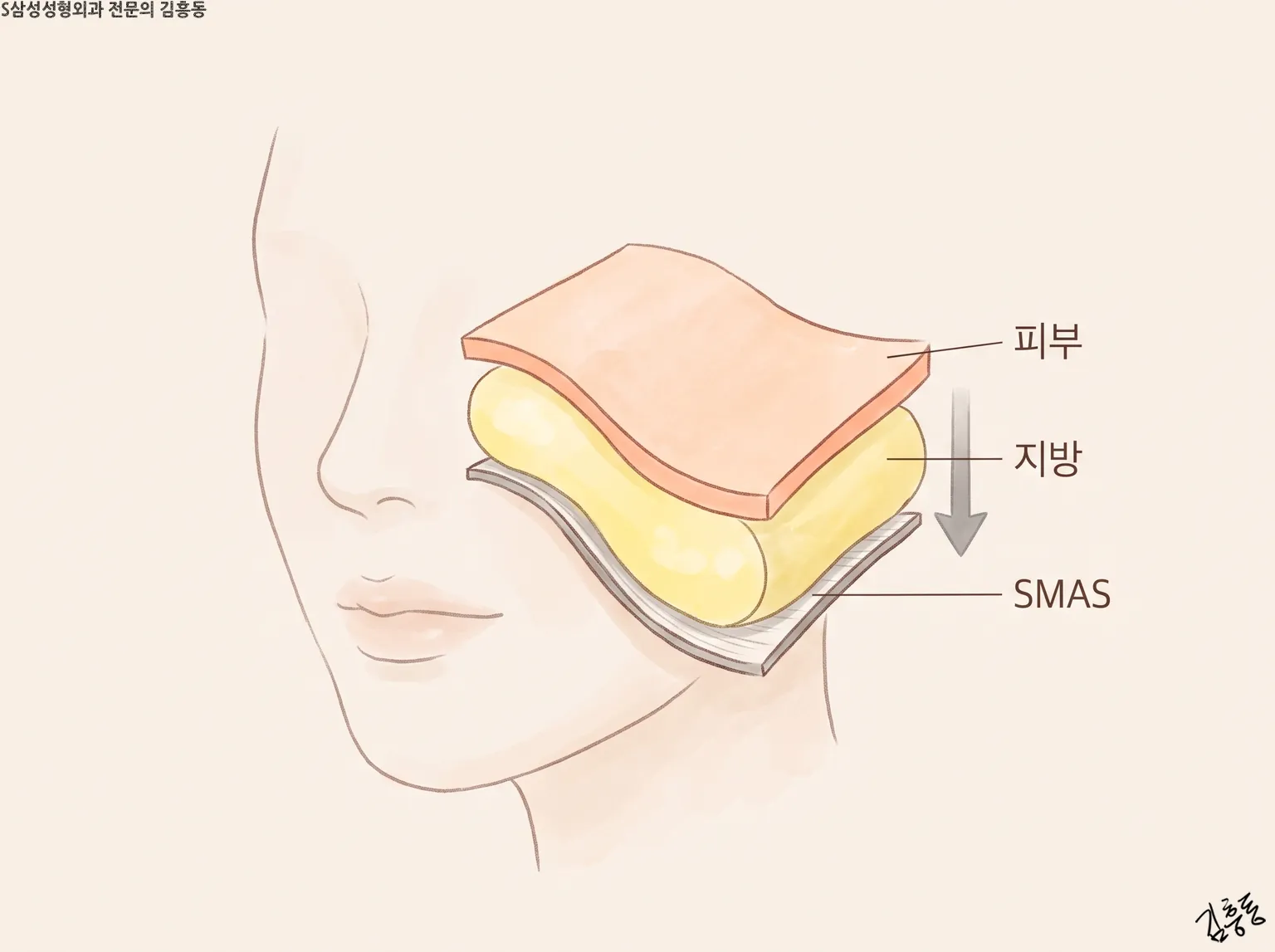 볼 위에 피부 · 지방 · SMAS 세 층을 겹쳐 그리고 아래로 향한 화살표를 둔 그림