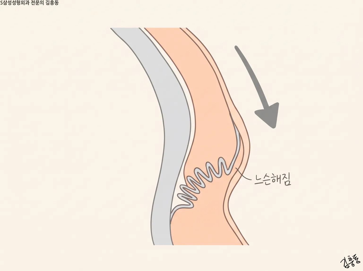 구불구불한 안쪽 층에 「느슨해짐」 이름표가 붙고 아래로 향한 화살표가 있는 단면 도식 그림