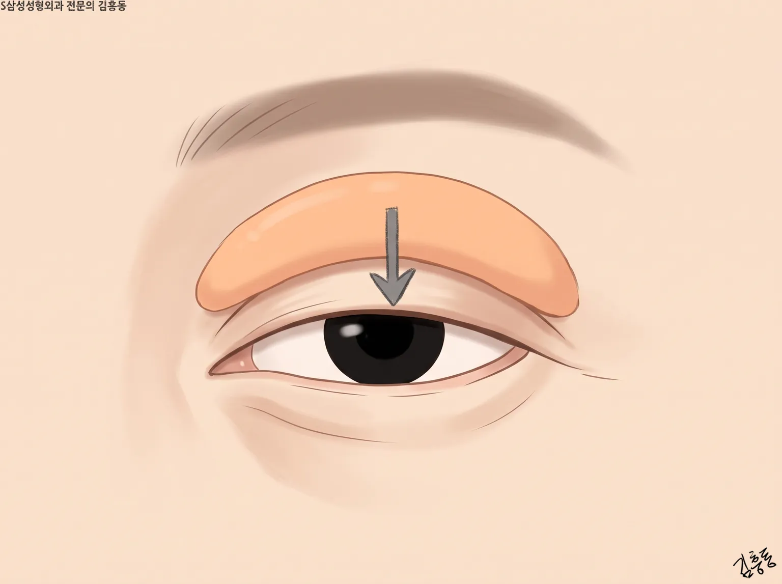 눈썹 아래 윗눈꺼풀 자리를 주황색으로 칠하고 아래로 향한 화살표를 둔 한쪽 눈 그림