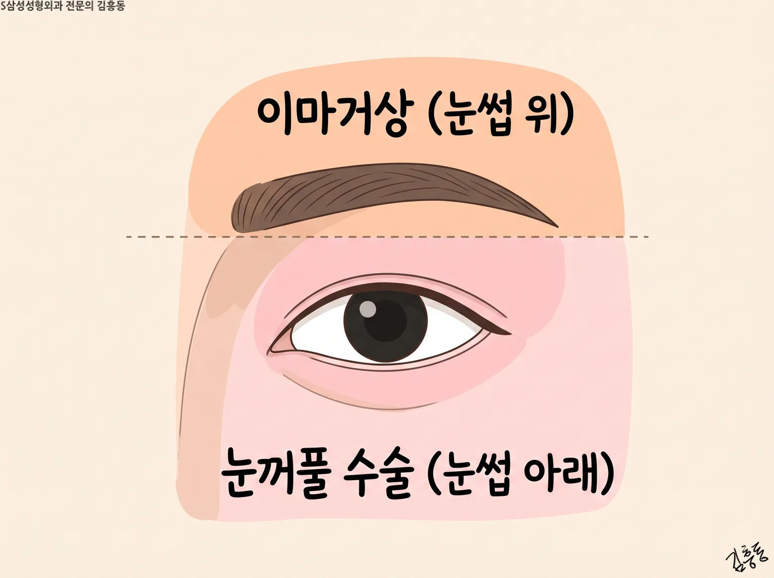 눈썹 위는 「이마거상」, 눈썹 아래는 「눈꺼풀 수술」이라 적어 점선으로 나눈 한쪽 눈 그림