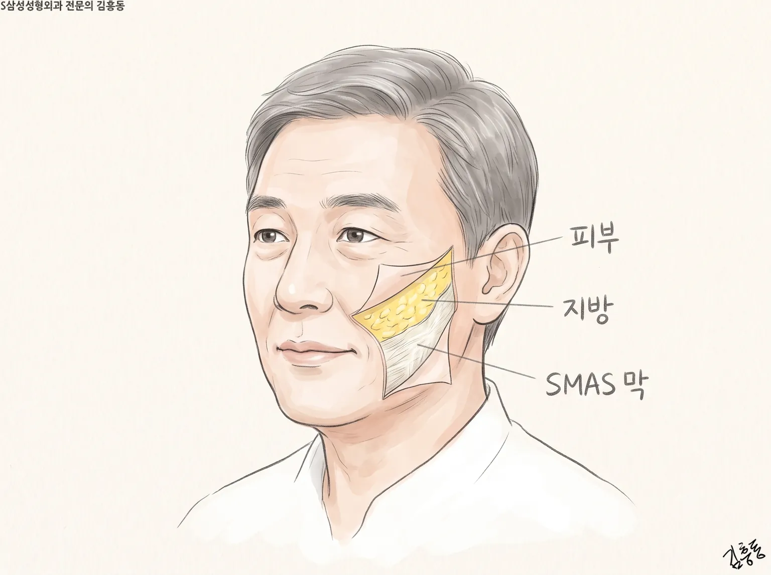 볼 한쪽에 피부 · 지방 · SMAS 막 이름표를 붙여 층을 나누어 보인 남성 얼굴 그림