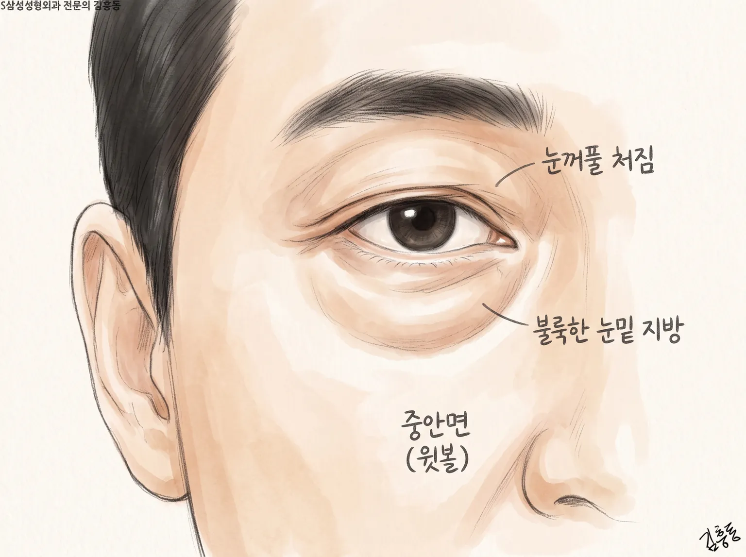 눈꺼풀 처짐 · 불룩한 눈밑 지방 · 중안면(윗볼) 이름표가 붙은 한쪽 눈과 볼 그림