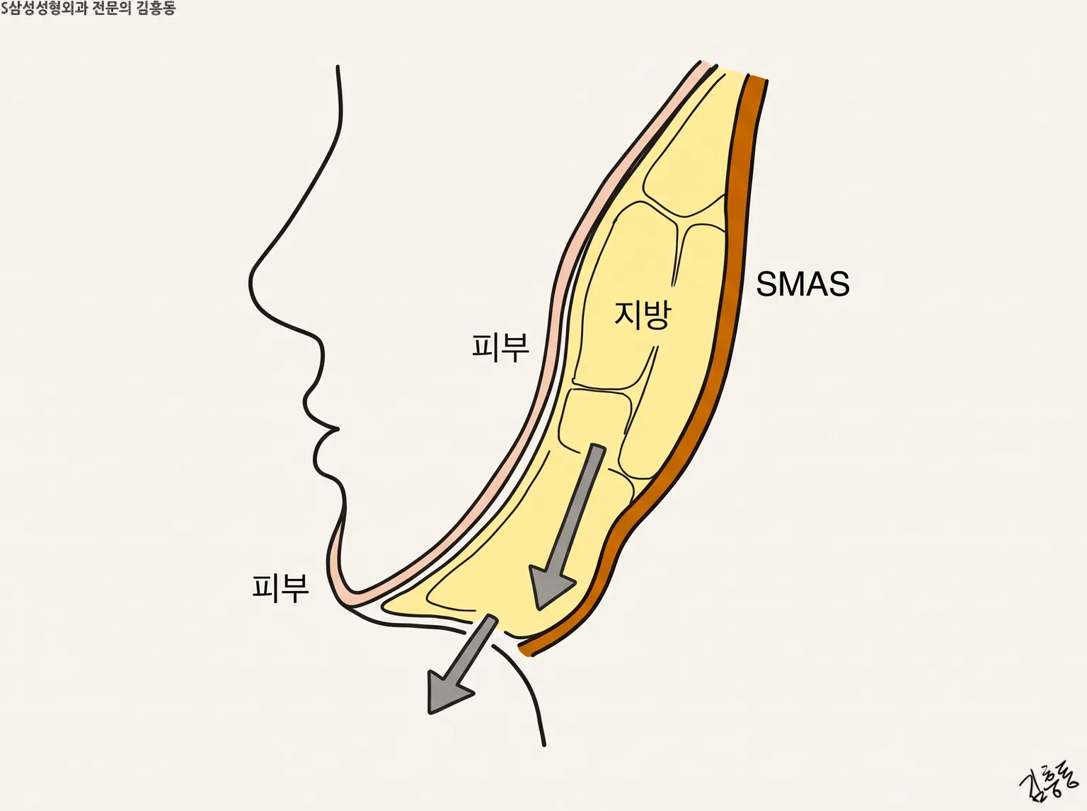 옆얼굴 선 옆에 피부 · 지방 · SMAS 세 층과 아래로 향한 화살표를 그린 볼 단면 도식