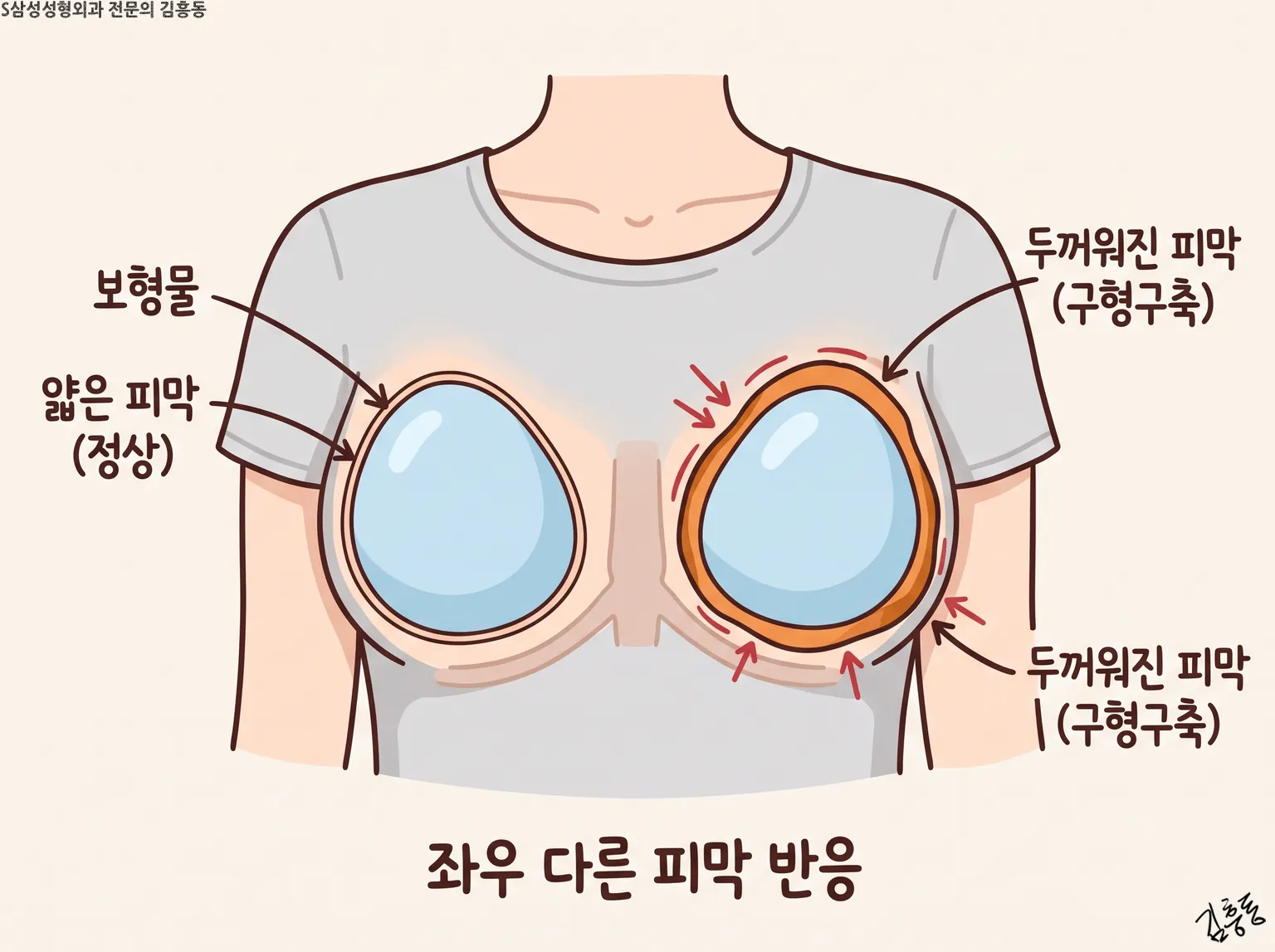 정면에서 본 좌우 보형물 가운데 한쪽만 두꺼운 피막에 싸인 모습, 이름표는 보형물 얇은 피막 두꺼워진 피막 셋만