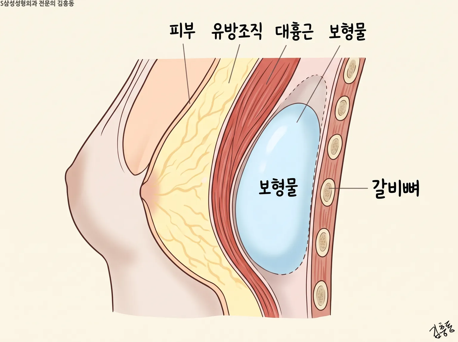 옆에서 본 가슴 단면, 앞에서부터 피부 유방조직 대흉근 보형물 갈비뼈 차례, 이름표는 이 다섯만