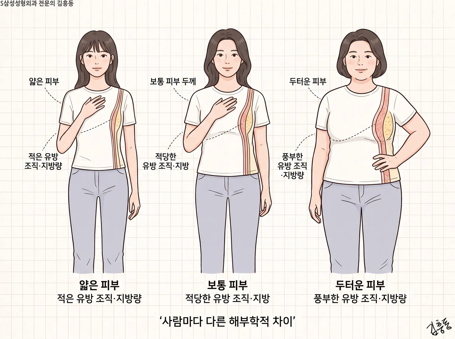 피부 두께와 유방조직 지방량이 서로 다른 세 사람의 실루엣
