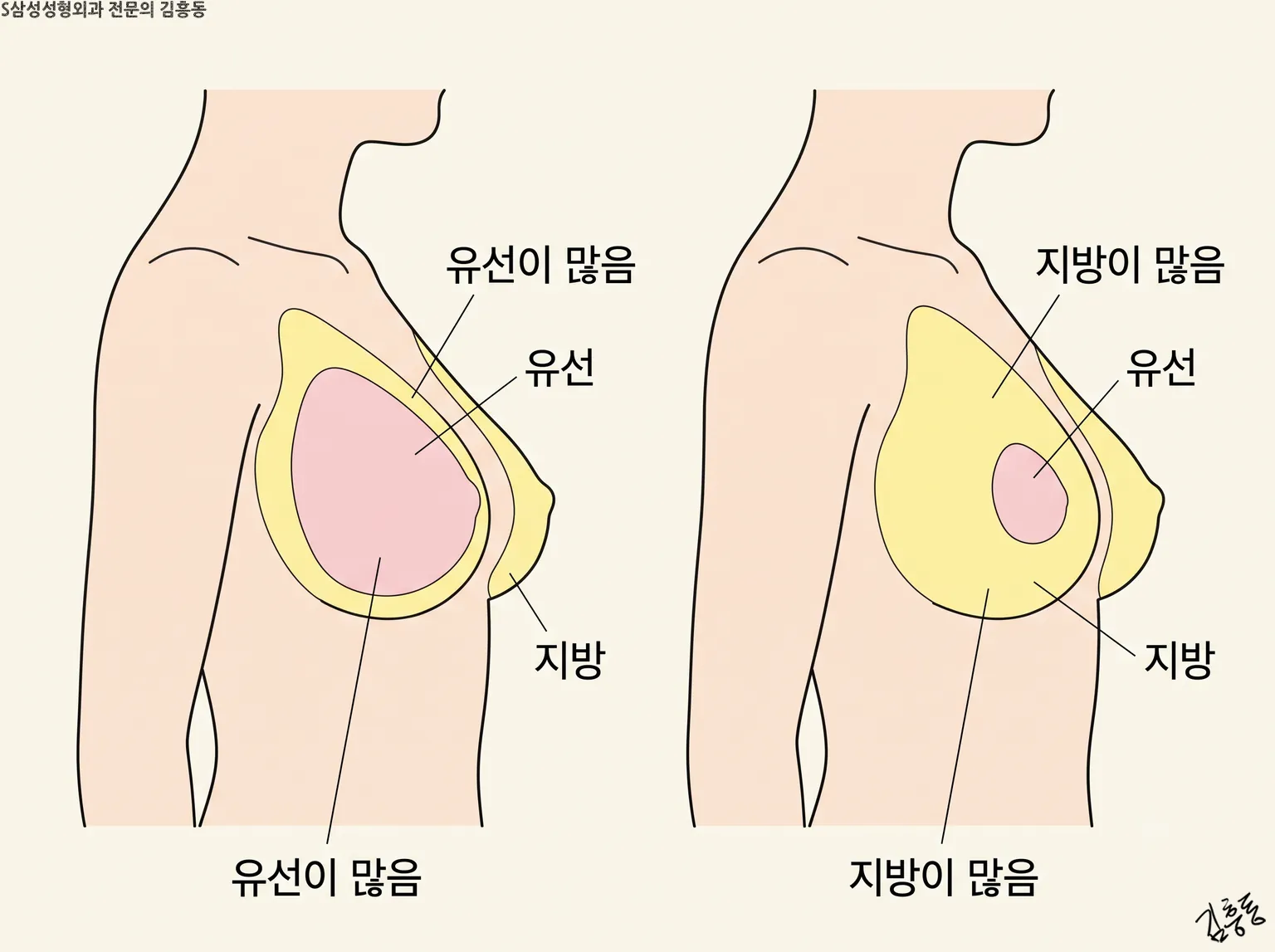 「유선이 많음」과 「지방이 많음」 이름표로 두 가슴 단면을 나란히 견준 그림