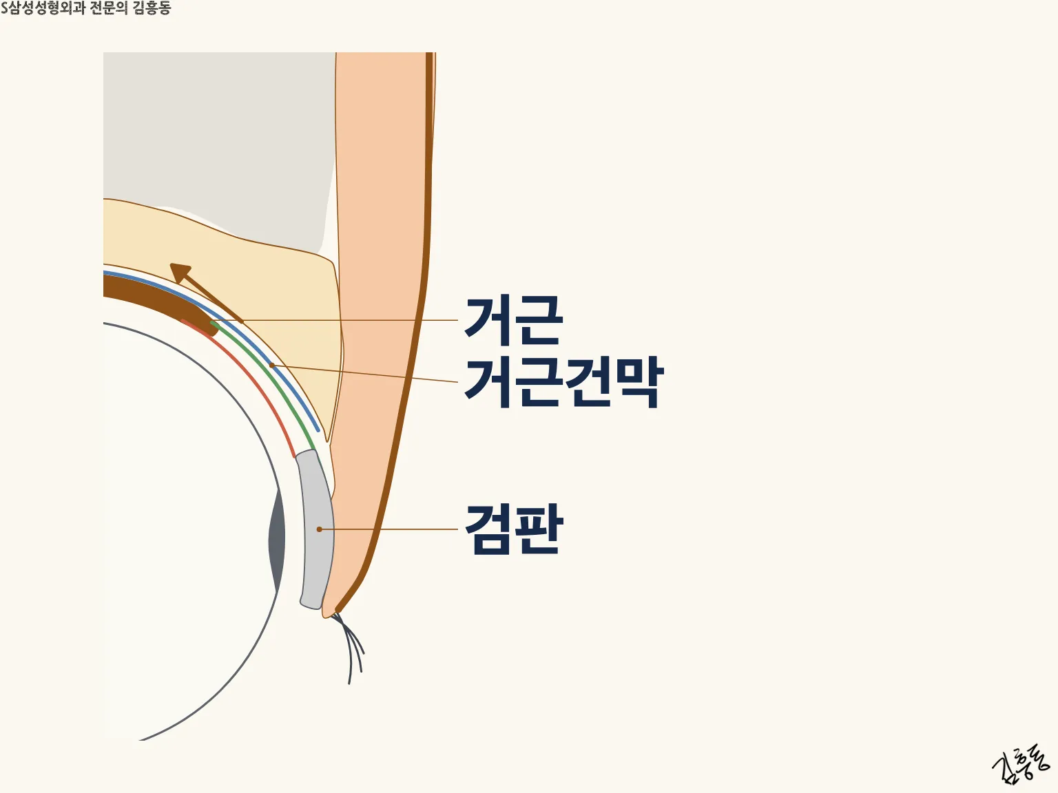윗눈꺼풀 단면에서 본 눈뜨는 근육(거근)과 검판