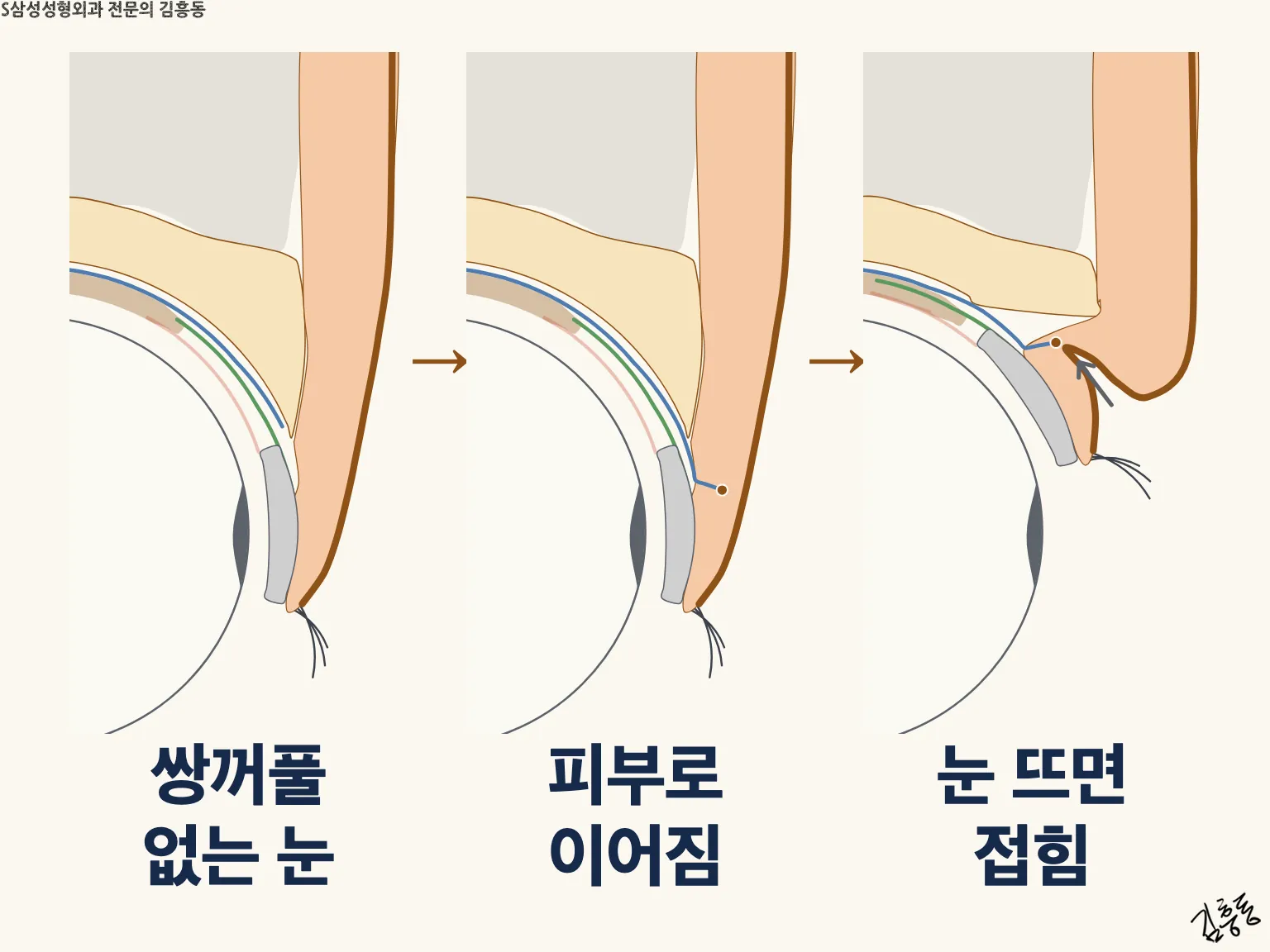 쌍꺼풀이 생기는 원리 세 장면: 쌍꺼풀 없는 눈, 피부로 이어짐, 눈 뜨면 접힘