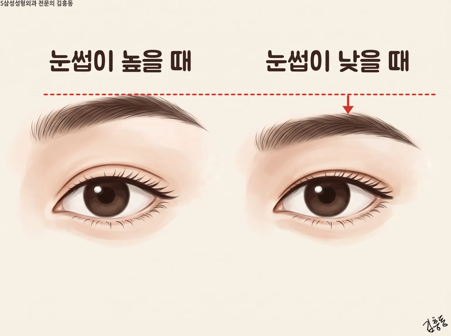 눈썹이 높을 때와 낮을 때 달라 보이는 쌍꺼풀 두께