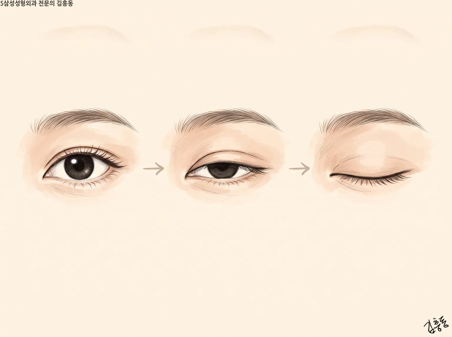 뜬 눈, 반쯤 감은 눈, 감은 눈에서 본 쌍꺼풀 높이