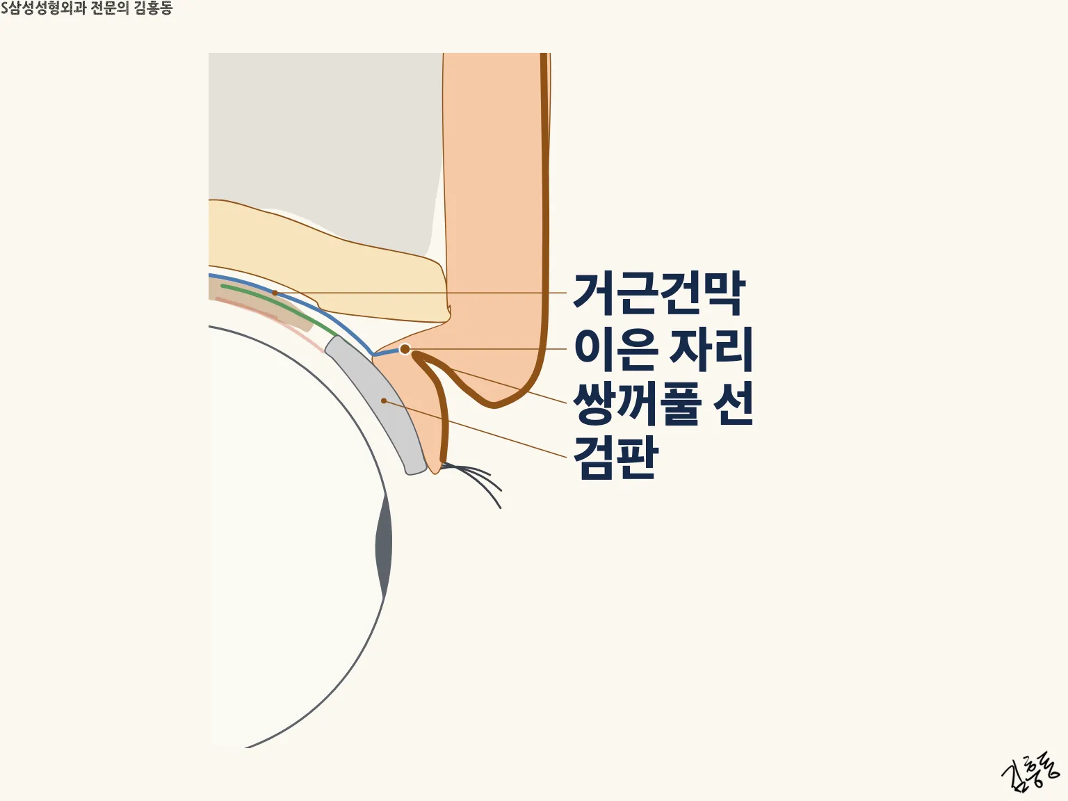 거근건막 · 이은 자리 · 쌍꺼풀 선 · 검판 이름표가 붙은 윗눈꺼풀 단면 그림
