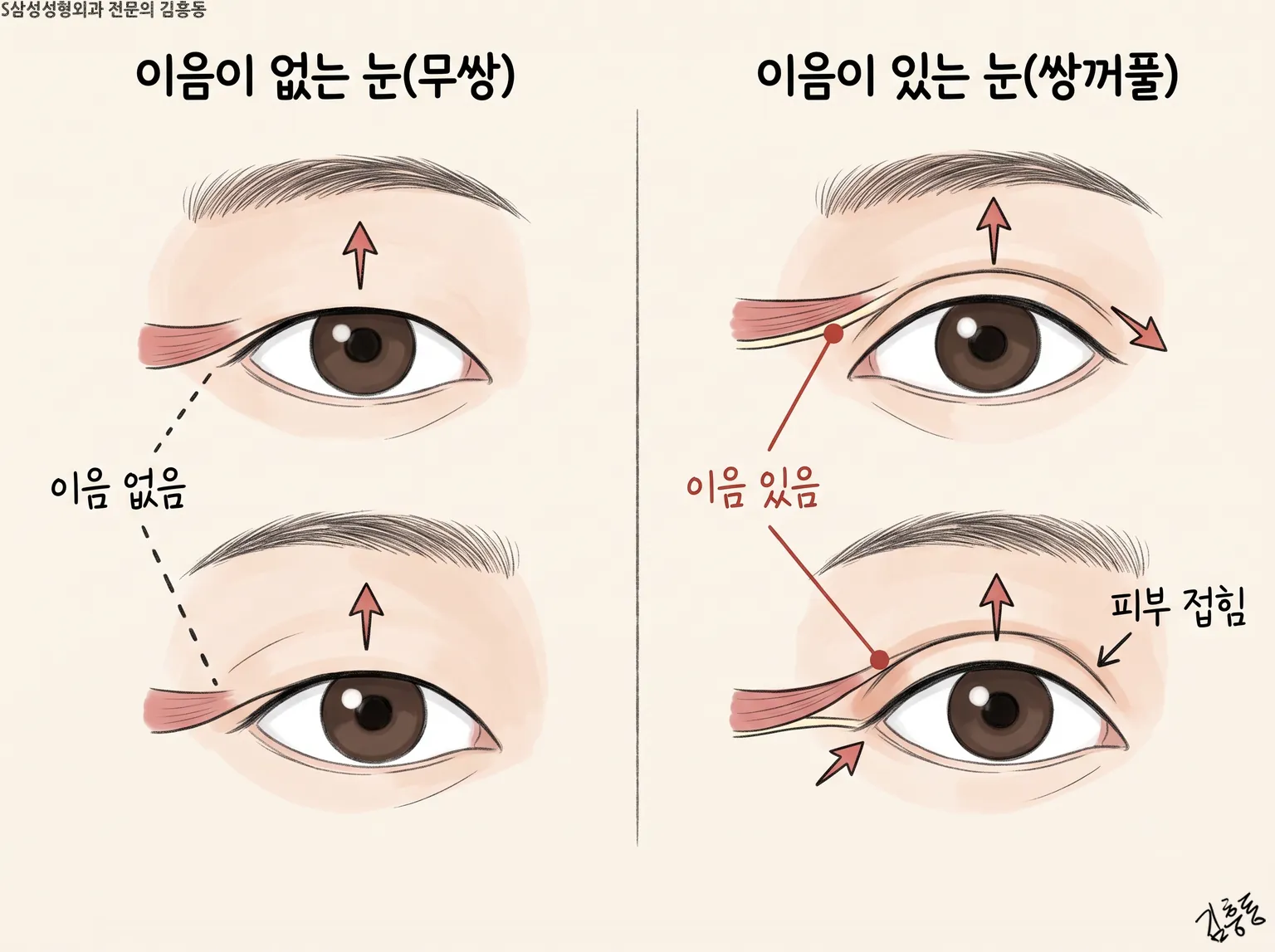이음이 없는 눈과 이음이 있는 눈이 떠질 때 피부가 접히는 차이를 나란히 그린 그림
