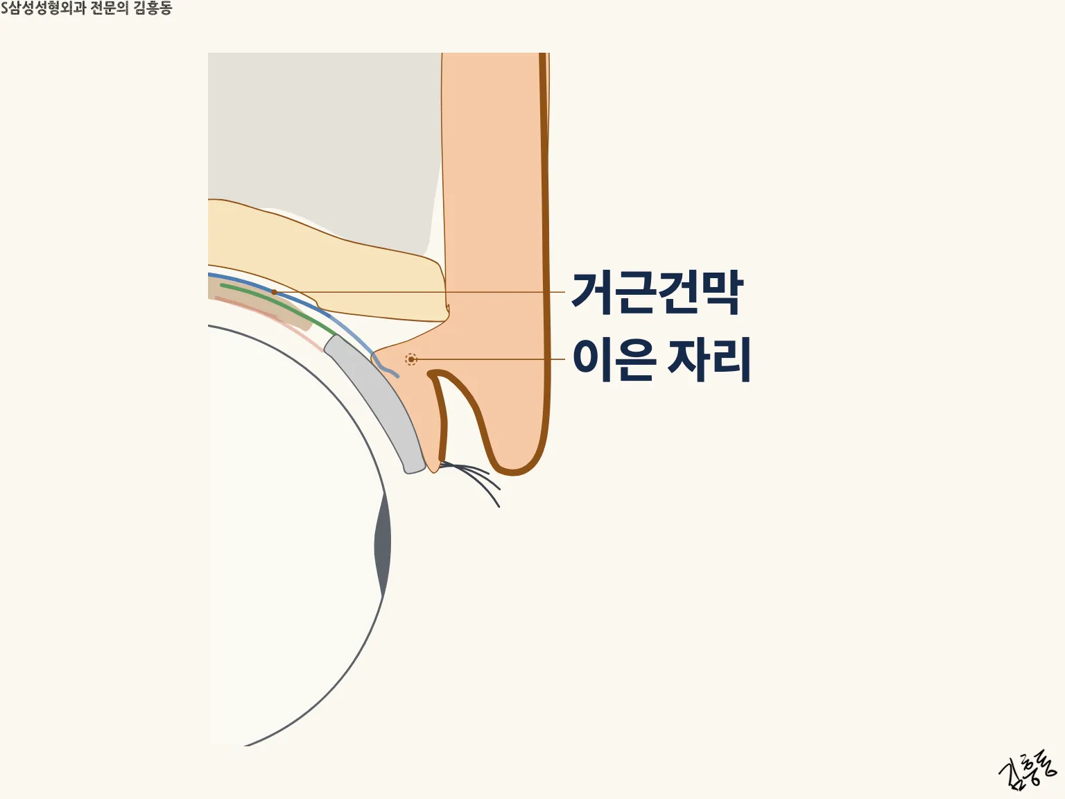 거근건막과 이은 자리 이름표만 남고 피부 쪽 접힘이 헐거워진 윗눈꺼풀 단면 그림