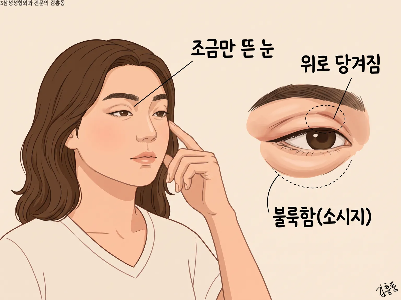 조금만 뜬 눈 · 위로 당겨짐 · 불룩함(소시지) 이름표를 단 여성과 눈 확대 그림