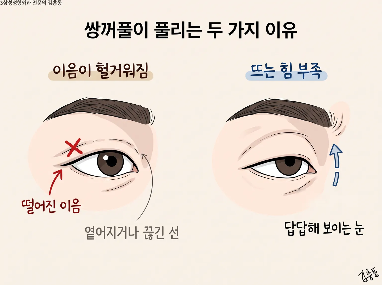 「쌍꺼풀이 풀리는 두 가지 이유」라는 제목이 적힌, 이음 헐거워짐과 뜨는 힘 부족 그림