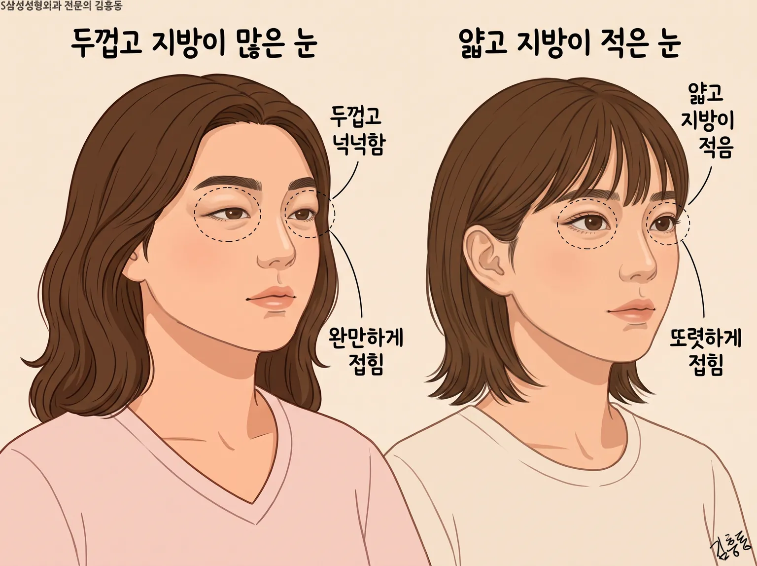 두껍고 지방이 많은 눈과 얇고 지방이 적은 눈의 접히는 모습을 나란히 둔 그림