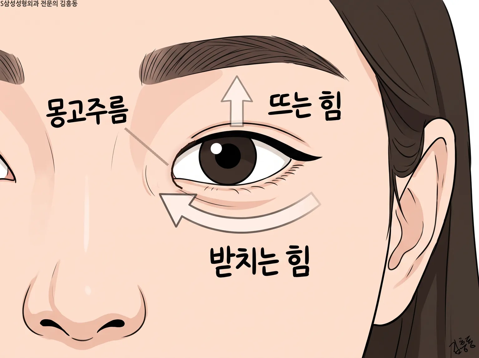 몽고주름 옆에 뜨는 힘과 받치는 힘을 화살표로 나타낸 눈 도식 그림